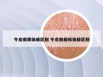 牛皮癣跟体癣区别 牛皮肤癣和体藓区别