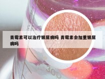 青霉素可以治疗银屑病吗 青霉素会加重银屑病吗