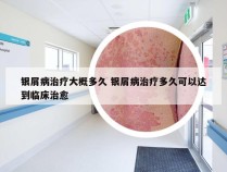 银屑病治疗大概多久 银屑病治疗多久可以达到临床治愈