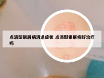 点滴型银屑病消退症状 点滴型银屑病好治疗吗