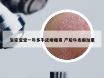 生完宝宝一年多牛皮癣爆发 产后牛皮癣加重