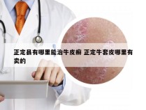 正定县有哪里能治牛皮癣 正定牛套皮哪里有卖的