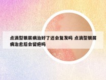 点滴型银屑病治好了还会复发吗 点滴型银屑病治愈后会留疤吗