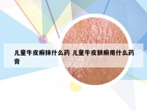 儿童牛皮癣抹什么药 儿童牛皮肤癣用什么药膏