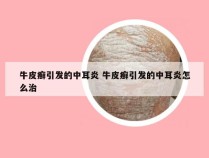 牛皮癣引发的中耳炎 牛皮癣引发的中耳炎怎么治