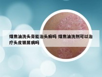 煤焦油洗头膏能治头癣吗 煤焦油洗剂可以治疗头皮银屑病吗
