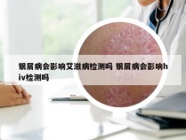 银屑病会影响艾滋病检测吗 银屑病会影响hiv检测吗