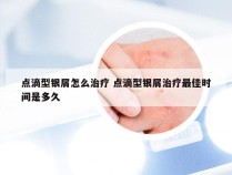 点滴型银屑怎么治疗 点滴型银屑治疗最佳时间是多久