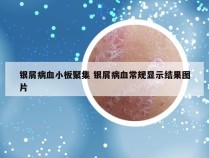 银屑病血小板聚集 银屑病血常规显示结果图片