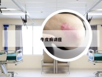 牛皮癣讲座