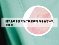 朗千金草本乳膏治疗银屑病吗 朗千金草本乳膏作用