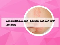 生物制剂管牛皮癣吗 生物制剂治疗牛皮癣可以根治吗