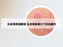 头皮银屑病图谱 头皮银屑病三个阶段图片