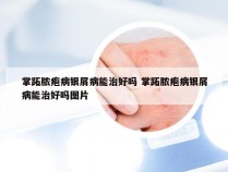 掌跖脓疱病银屑病能治好吗 掌跖脓疱病银屑病能治好吗图片