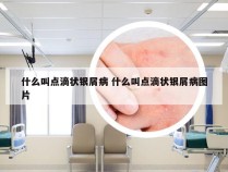 什么叫点滴状银屑病 什么叫点滴状银屑病图片
