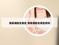 银屑病脱皮黑色 银屑病脱皮黑色斑块