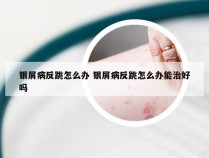 银屑病反跳怎么办 银屑病反跳怎么办能治好吗