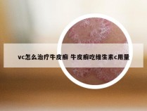 vc怎么治疗牛皮癣 牛皮癣吃维生素c用量