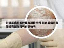 副银屑病照紫外线有副作用吗 副银屑病照紫外线有副作用吗有影响吗