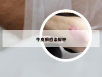 牛皮癣感染脚肿