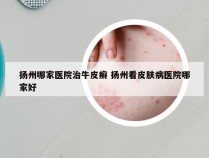 扬州哪家医院治牛皮癣 扬州看皮肤病医院哪家好