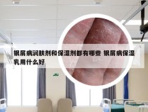 银屑病润肤剂和保湿剂都有哪些 银屑病保湿乳用什么好