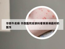 华西牛皮癣 华西医院皮肤科看银屑病最好的医生