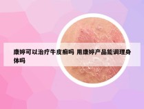 康婷可以治疗牛皮癣吗 用康婷产品能调理身体吗