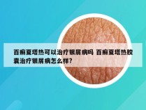 百癣夏塔热可以治疗银屑病吗 百癣夏塔热胶囊治疗银屑病怎么样?