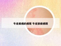 牛皮癣病的病理 牛皮肤癣病理