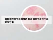 银屑病性关节炎的用药 银屑病关节炎吃什么药有效果