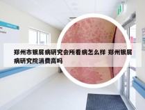 郑州市银屑病研究会所看病怎么样 郑州银屑病研究院消费高吗