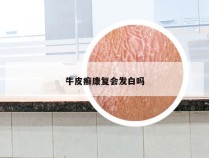 牛皮癣康复会发白吗