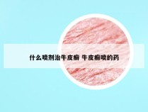 什么喷剂治牛皮癣 牛皮癣喷的药