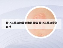 骨化三醇软胶囊能治银屑病 骨化三醇软膏怎么样