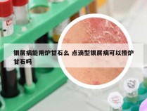 银屑病能用炉甘石么 点滴型银屑病可以擦炉甘石吗