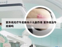 紫外线光疗牛皮癣有什么副作用 紫外线治牛皮癣吗