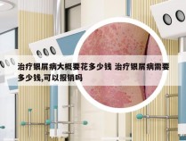 治疗银屑病大概要花多少钱 治疗银屑病需要多少钱,可以报销吗