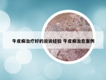 牛皮癣治疗好的说说经验 牛皮癣治愈案例