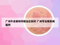 广州牛皮癣如何根治比较好 广州专治银屑病医院