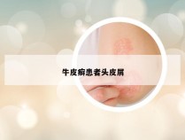 牛皮癣患者头皮屑