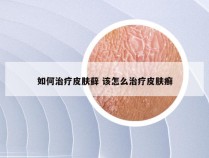 如何治疗皮肤藓 该怎么治疗皮肤癣