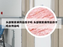 头部银屑病传染孩子吗 头部银屑病传染孩子吗会传染吗