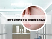 寻常银屑病刺痛瘙痒 银屑病瘙痒怎么办