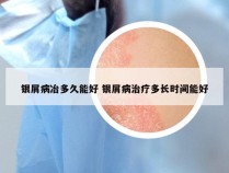 银屑病冶多久能好 银屑病治疗多长时间能好