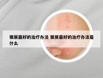 银屑最好的治疗办法 银屑最好的治疗办法是什么