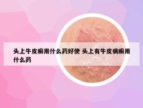 头上牛皮癣用什么药好使 头上有牛皮病癣用什么药