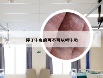 得了牛皮癣可不可以喝牛奶