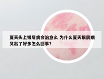 夏天头上银屑病会治愈么 为什么夏天银屑病又出了好多怎么回事?