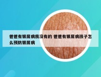 爸爸有银屑病我没有的 爸爸有银屑病孩子怎么预防银屑病